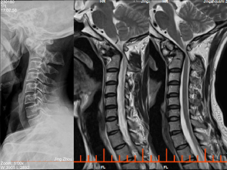 颅颈交界区畸形.ppt_第2页