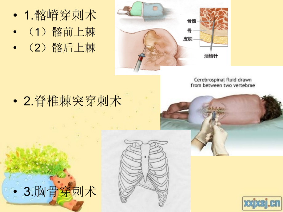 骨髓穿刺术演稿.ppt_第2页