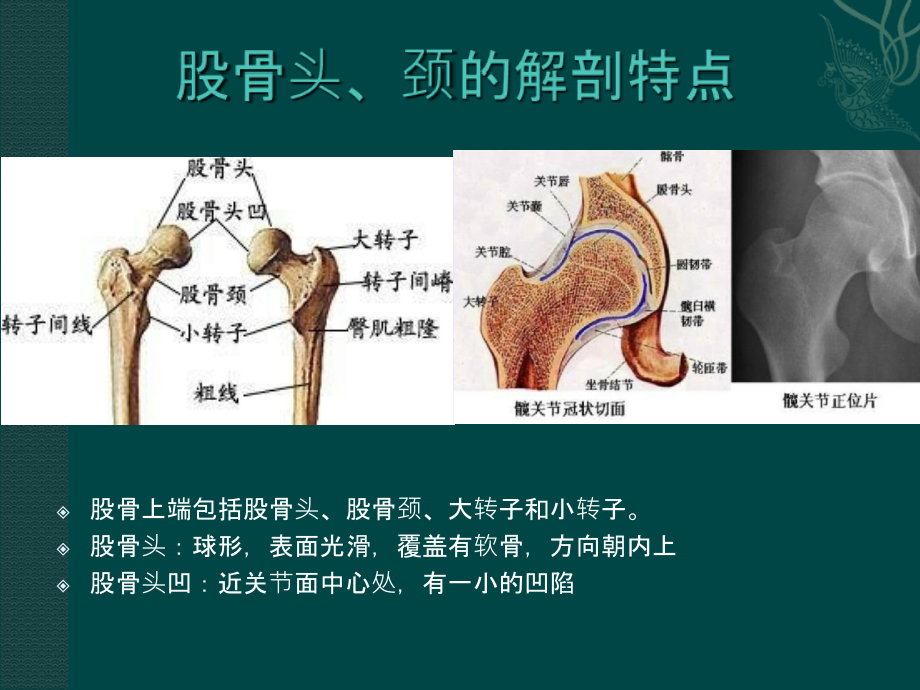 股骨头缺血性坏死-医学课件.ppt_第2页