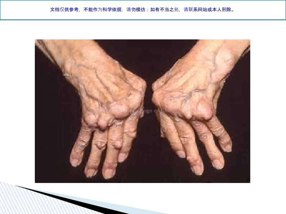 类风湿性关节炎健康教育课件.ppt_第2页