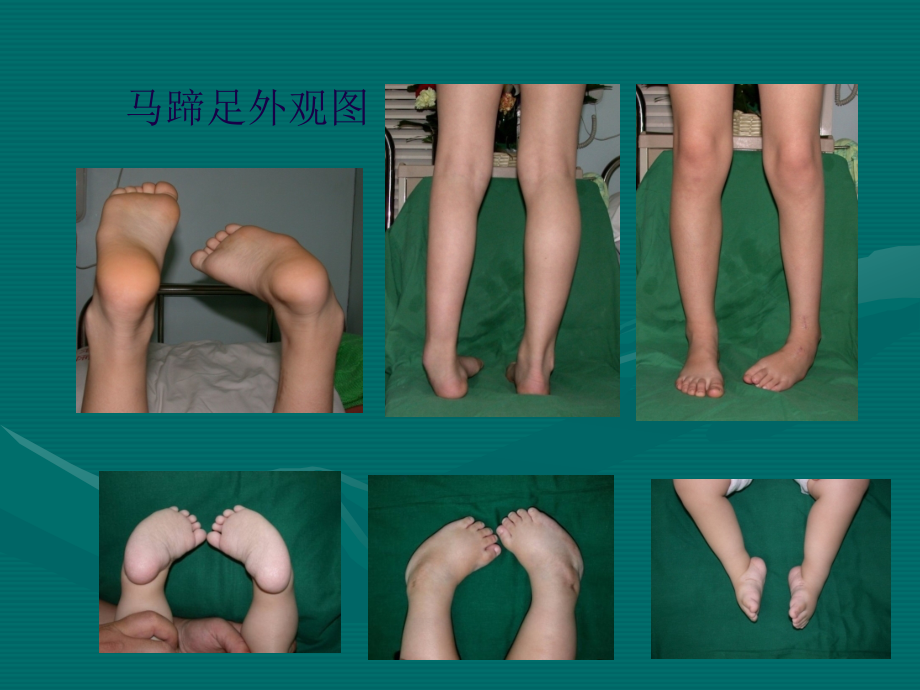 先天性马蹄内翻足的康复.pptx_第2页