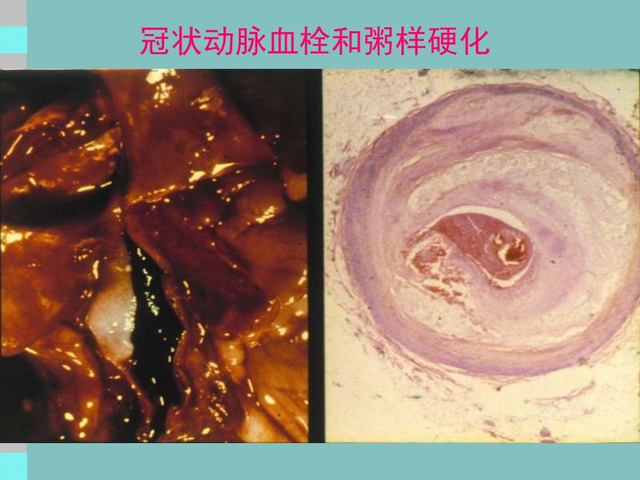 冠状动脉粥样硬化性心脏病(CHD)培训课件.ppt_第2页