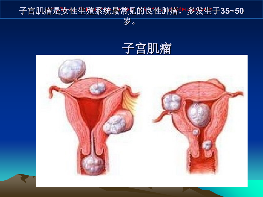 子宫肌瘤专题宣讲培训课件.ppt_第1页