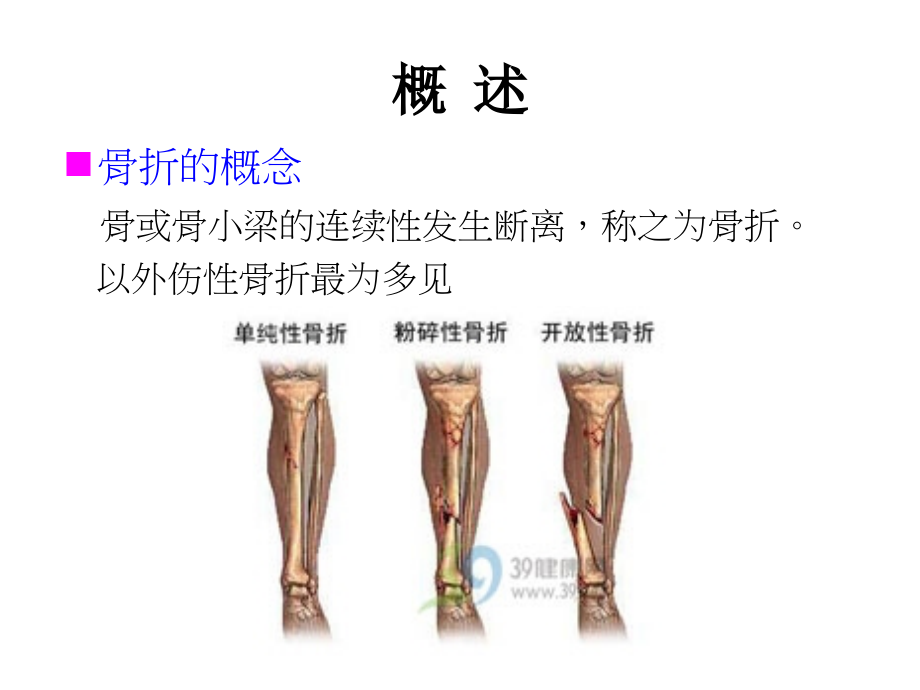 骨折後的康复治疗.ppt_第1页
