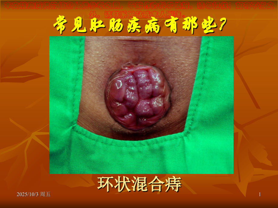 肛肠科科普知识宣讲培训课件.ppt_第1页