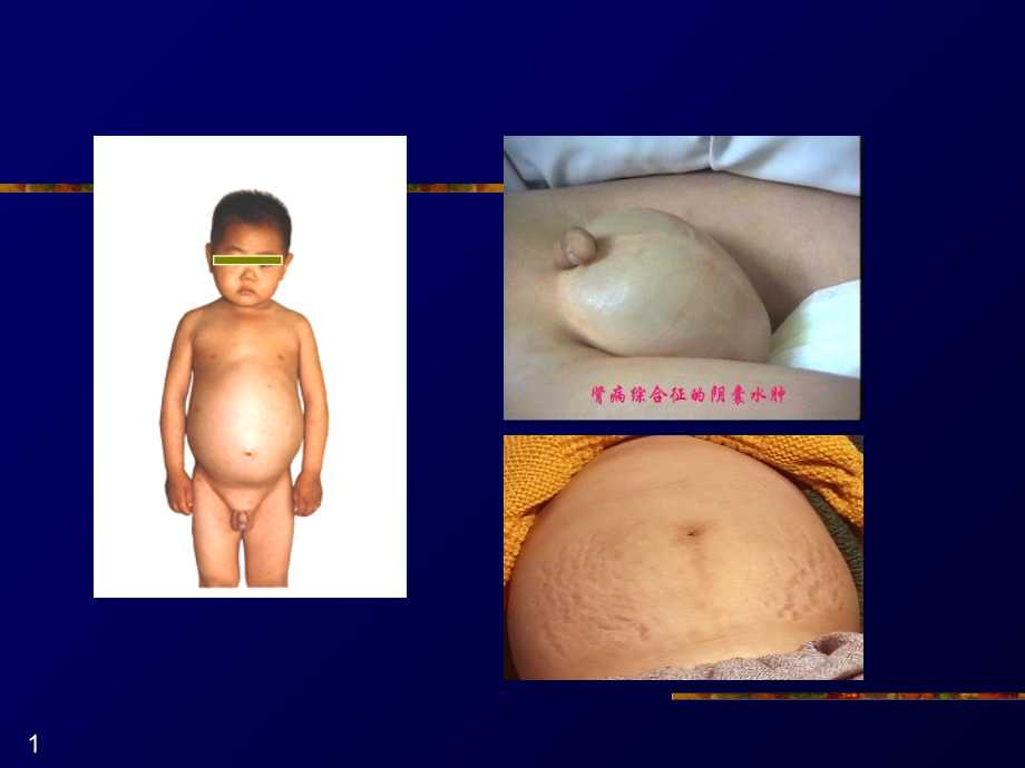 重庆医科大学《临床医学概论》之肾病教学.ppt_第1页