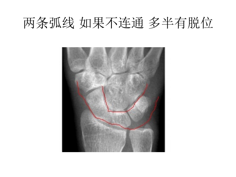 腕关节阅片技巧.ppt_第2页