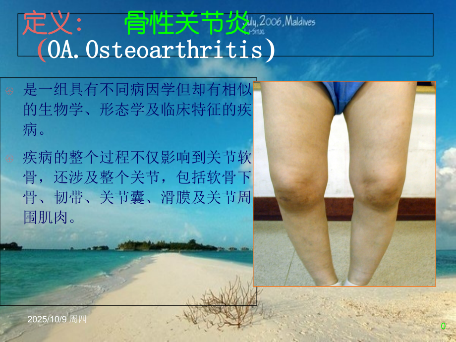 膝关节骨性关节和人工膝关节置换护理查房.ppt_第1页