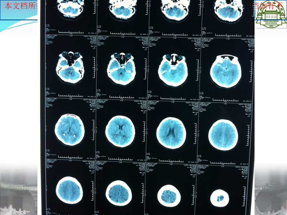 蛛网膜下腔出血病例讨论培训课件.ppt_第2页