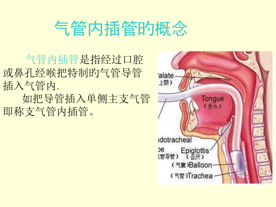 气管插管与肺隔离术.pptx_第2页