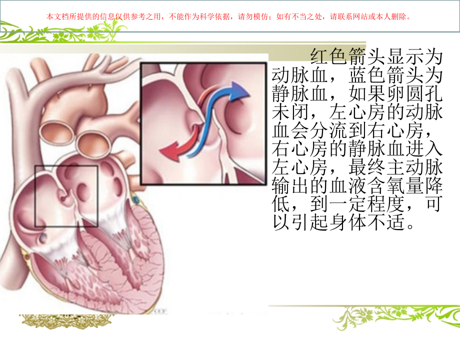 卵圆孔未闭的治疗及护理培训课件.ppt_第1页