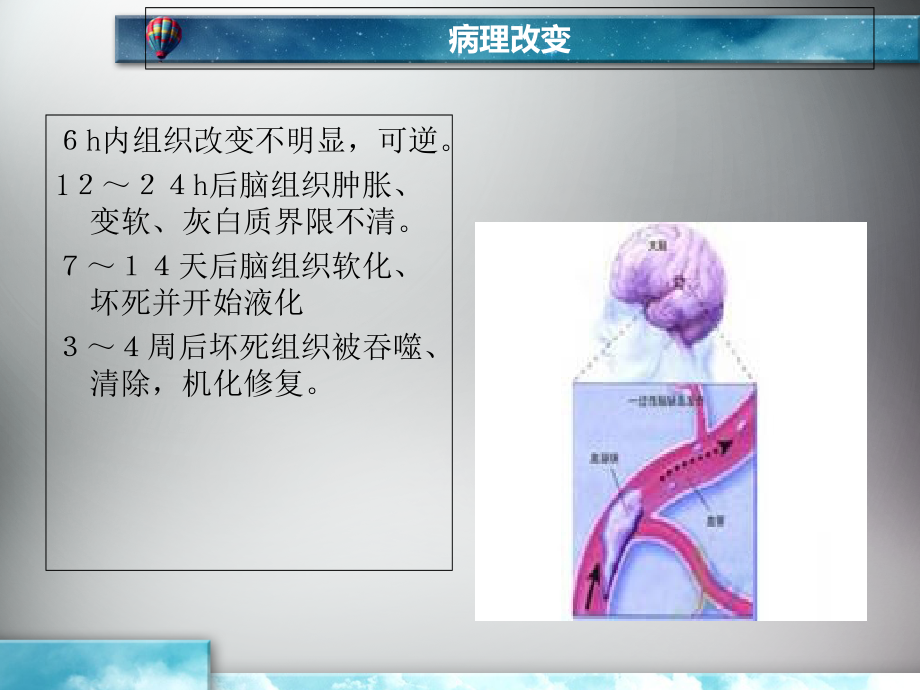 脑梗塞的护理查房2.ppt_第2页