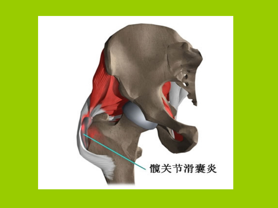 髋关节滑囊炎.ppt_第1页