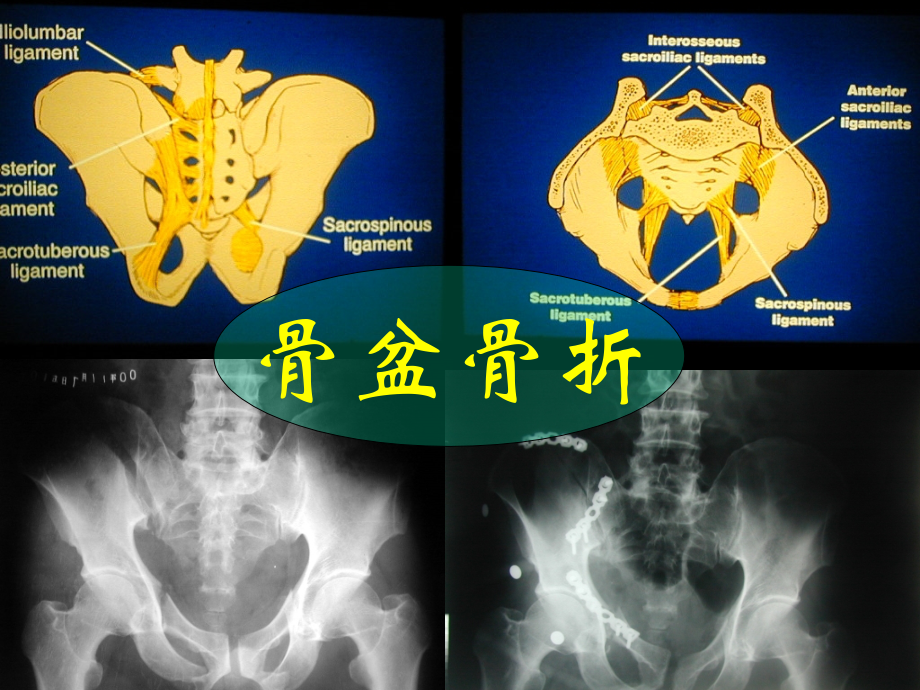 骨盆损伤.ppt_第1页