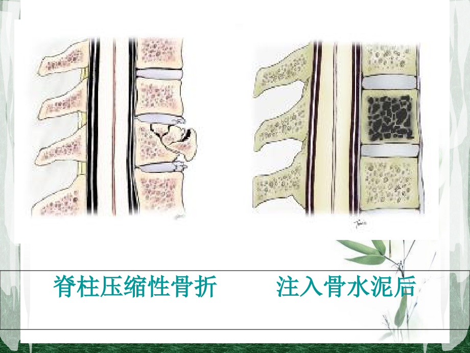 经皮穿刺椎体成形术.123演稿.ppt_第2页