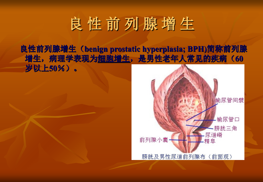 良性前列腺增生及超声消融简说.ppt_第1页