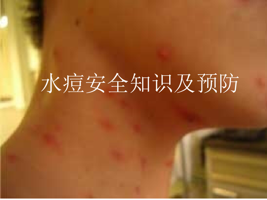 秋季水痘疫苗预防知识.ppt_第1页