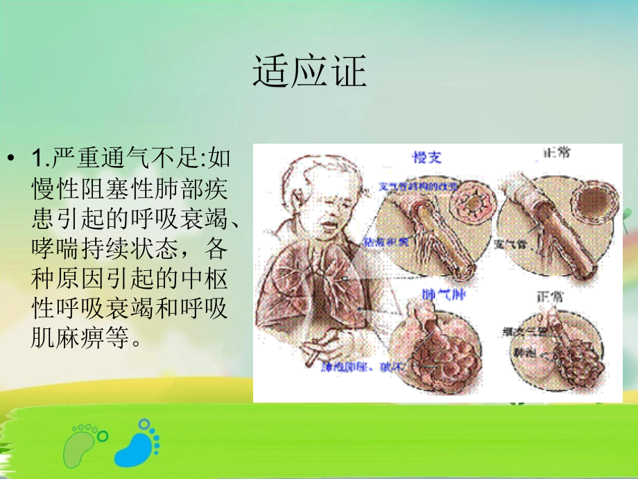 简易呼吸器的使用-龚婕.ppt_第2页