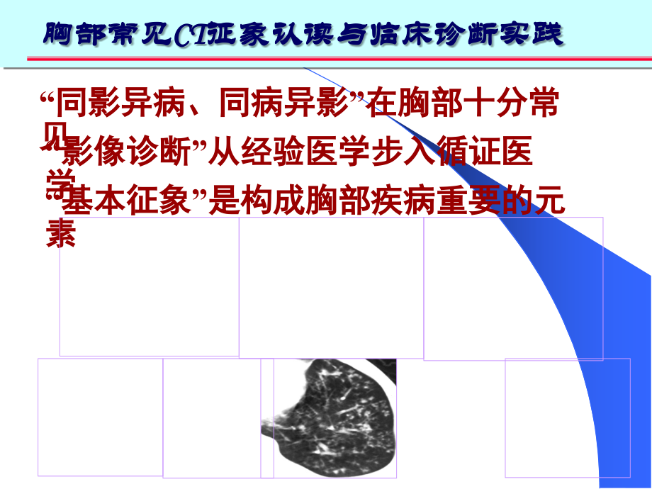 胸部常见CT征象.ppt_第2页