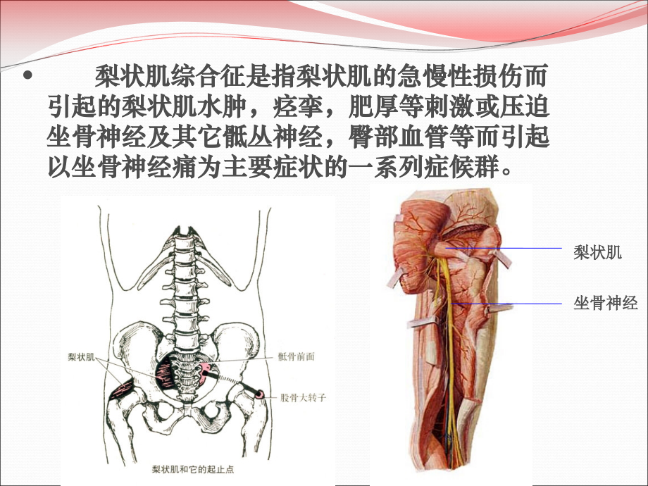 梨状肌松解.ppt_第2页