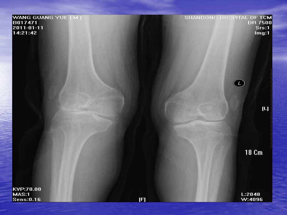 甲髌综合征.ppt_第2页