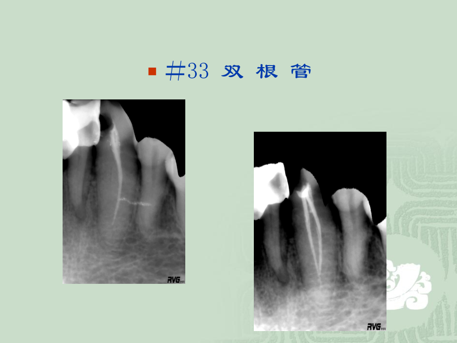 根管治疗的特殊问题与对策.ppt_第2页