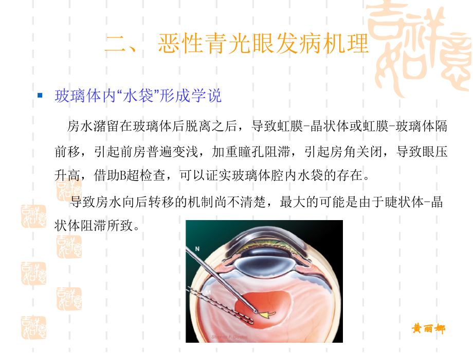 恶性青光眼幻灯片.ppt_第2页