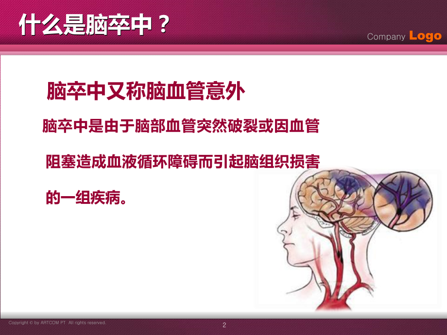 医学如何预防脑卒中.ppt_第2页