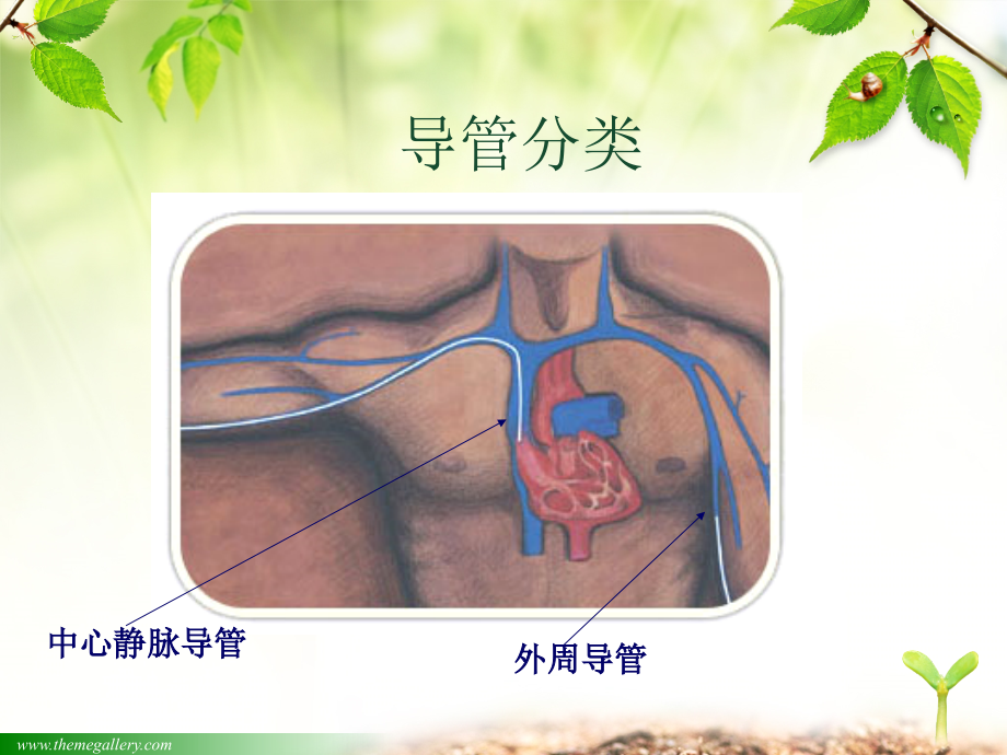 医学课件静脉留置针的临床应用.ppt_第2页