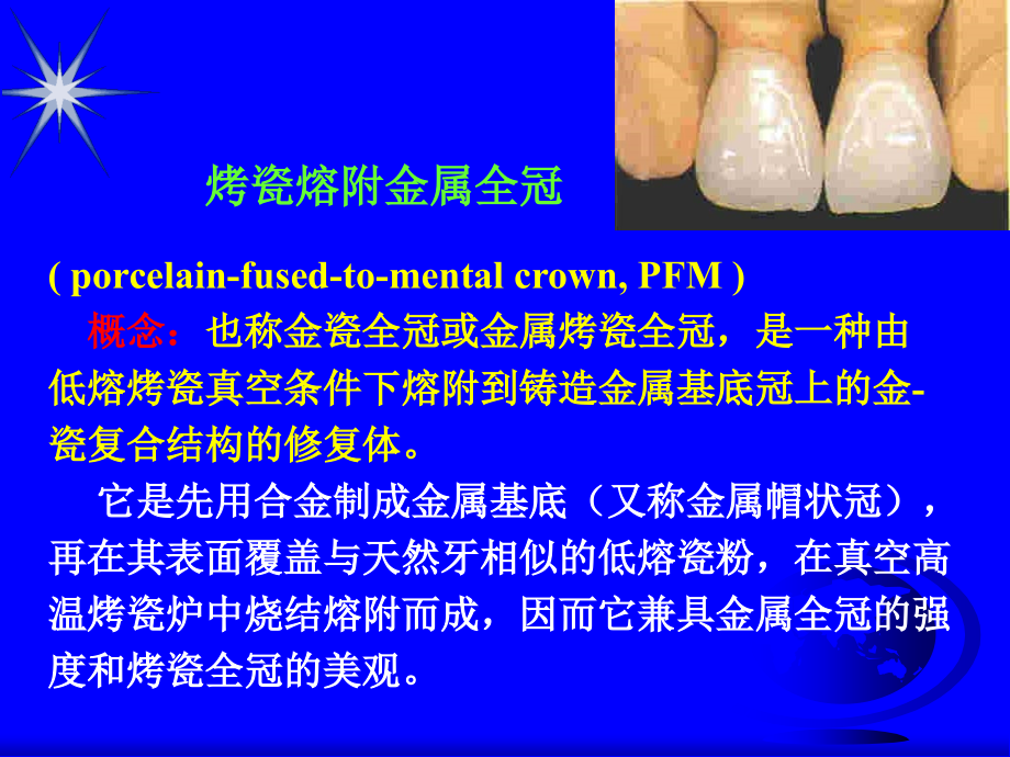 烤瓷熔附金属全冠.ppt_第1页