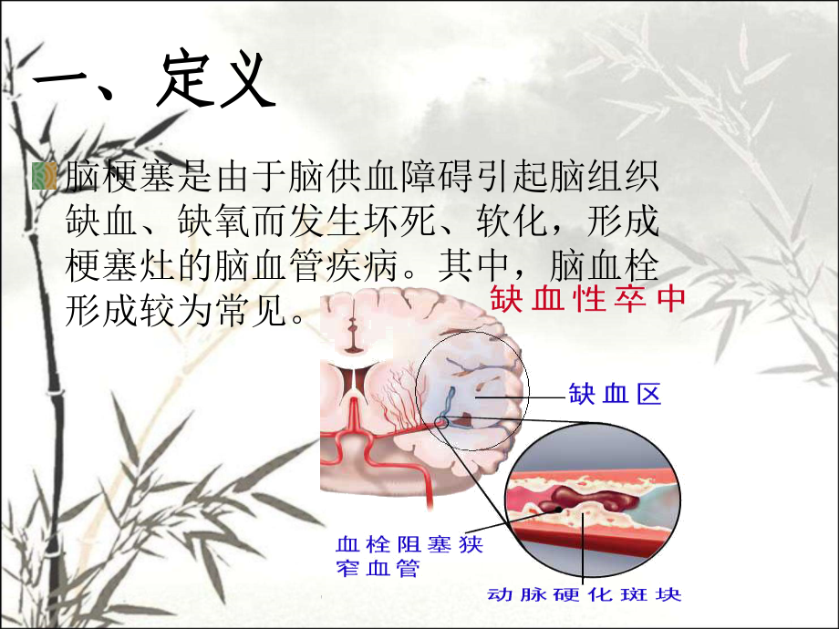 脑梗塞的护理常规课件.ppt_第2页