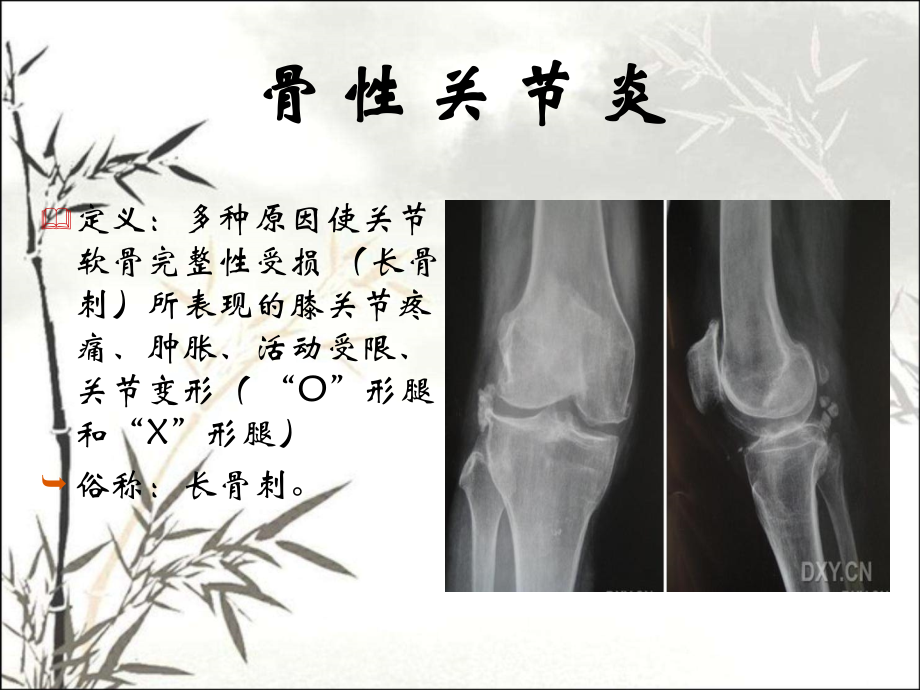 膝关节病健康教育课件.ppt_第2页