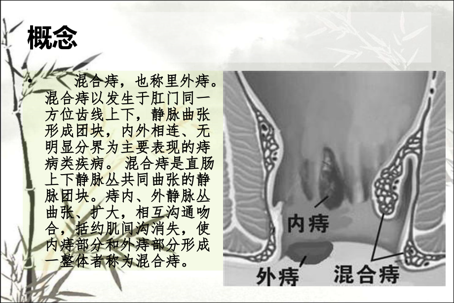 混合痔健康教育课件.ppt_第2页
