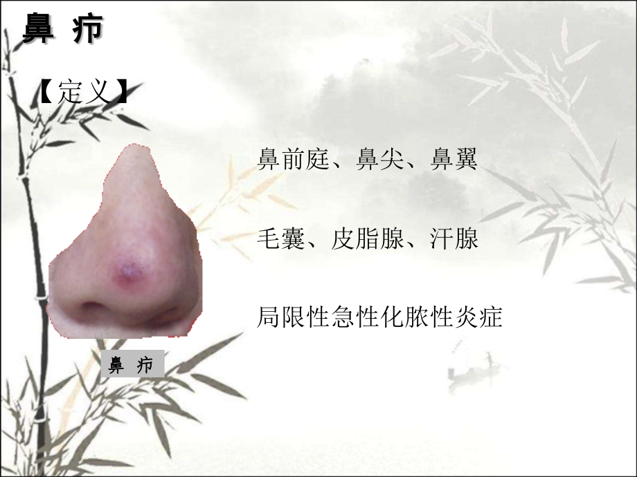 鼻部常见疾病病人的护理.ppt_第2页