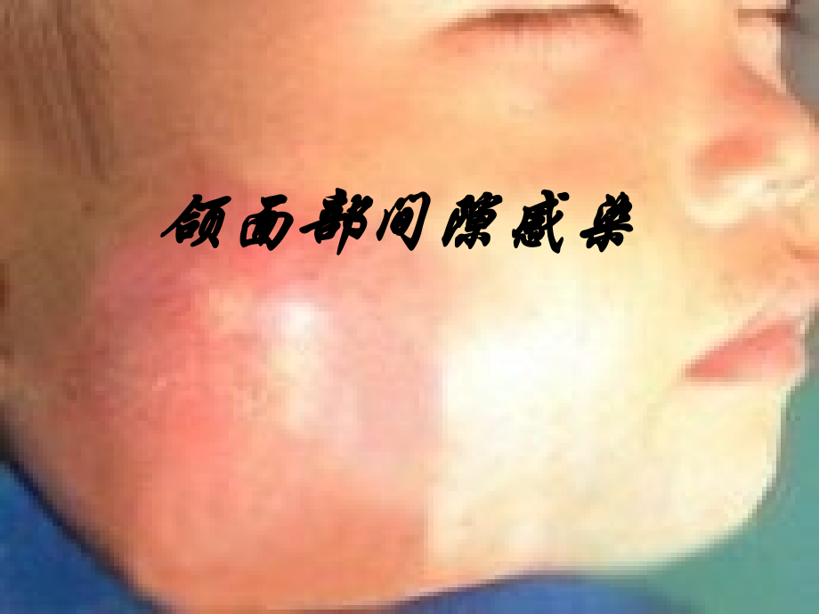 颌面部间隙感染课件.ppt_第1页