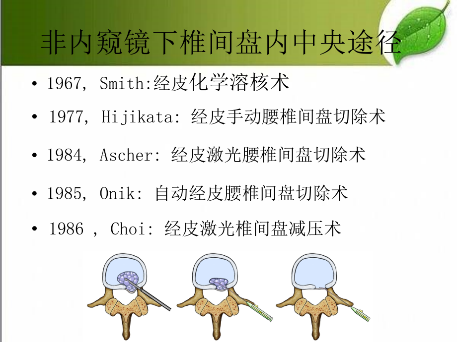 不同脊柱微创技术简介..ppt_第2页