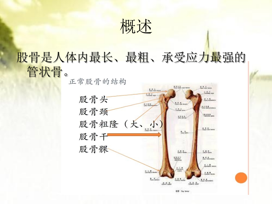 股骨骨折的健康宣教.ppt_第2页