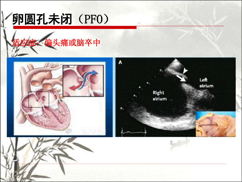 外科微创封堵治疗先心病的陷阱和应对策略.pptx_第2页