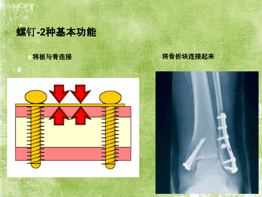 骨科基础螺钉设计与类型.ppt_第2页
