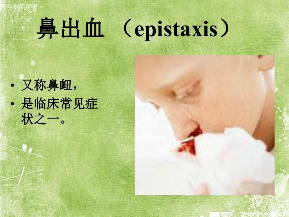 鼻出血病人的护理.ppt_第2页