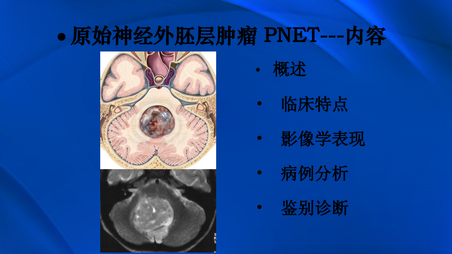 原始神经外胚层肿瘤.ppt_第2页