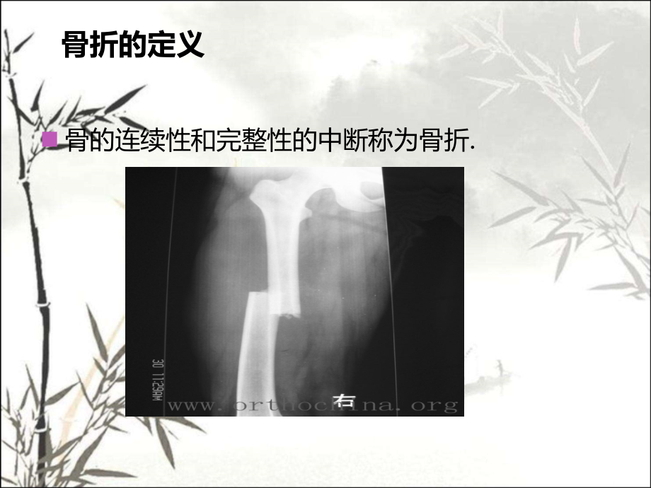 骨折及骨折内固定术后护理.ppt_第2页