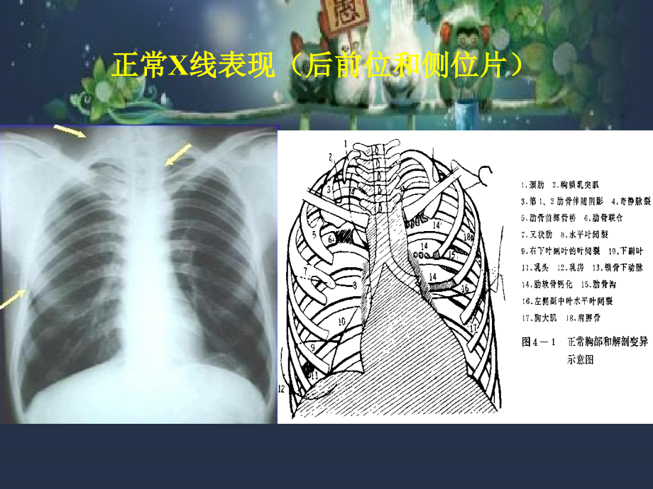 呼吸系统X线诊断常见胸片.ppt_第2页
