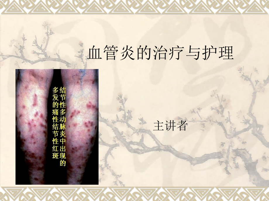 血管炎患者的治疗与护理.ppt_第1页