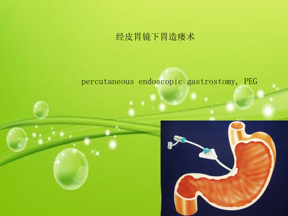 经皮胃镜下胃造瘘.ppt_第2页
