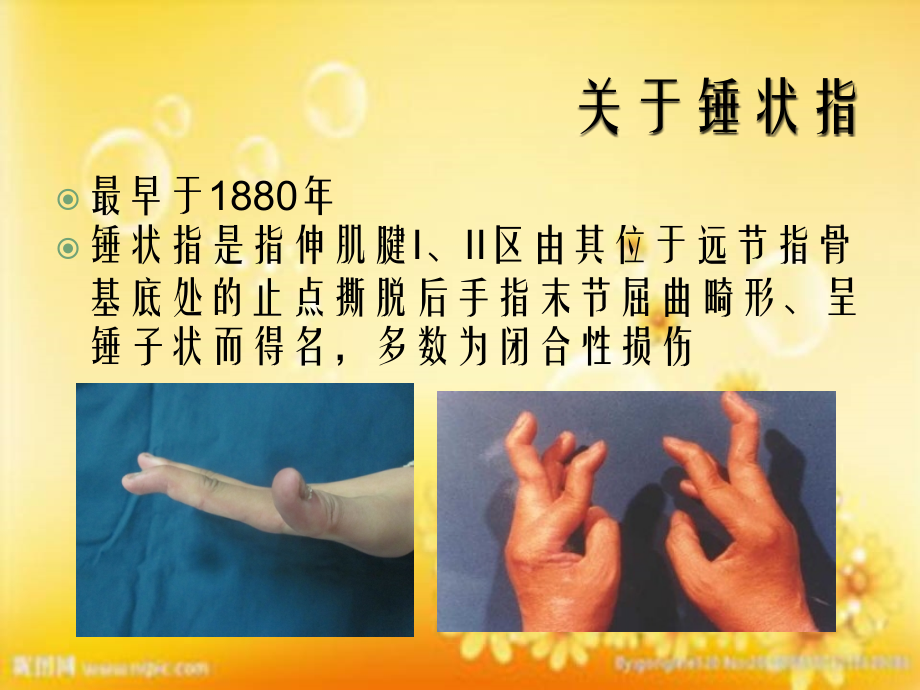 支具在锤状指康复中的应用.ppt_第2页