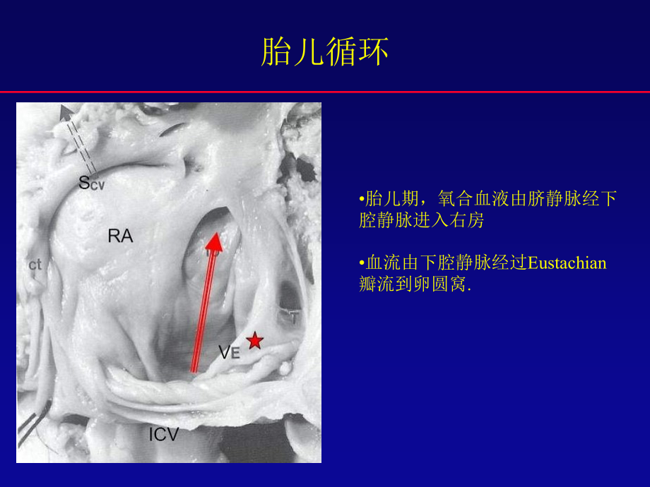 卵圆孔未闭封堵术的争论和发展.ppt_第2页