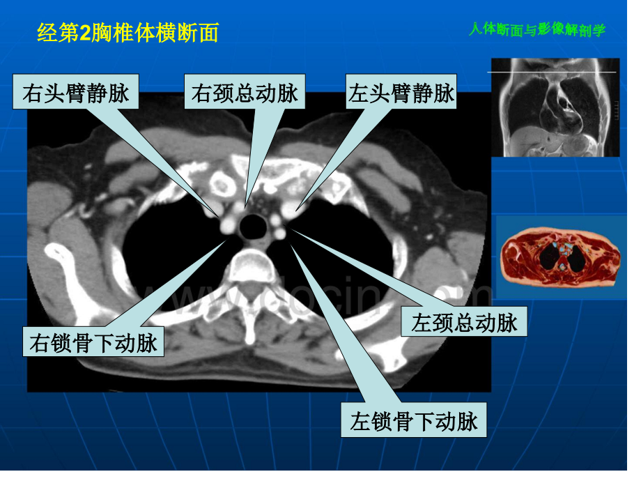 胸部CT全部介绍.pptx_第2页