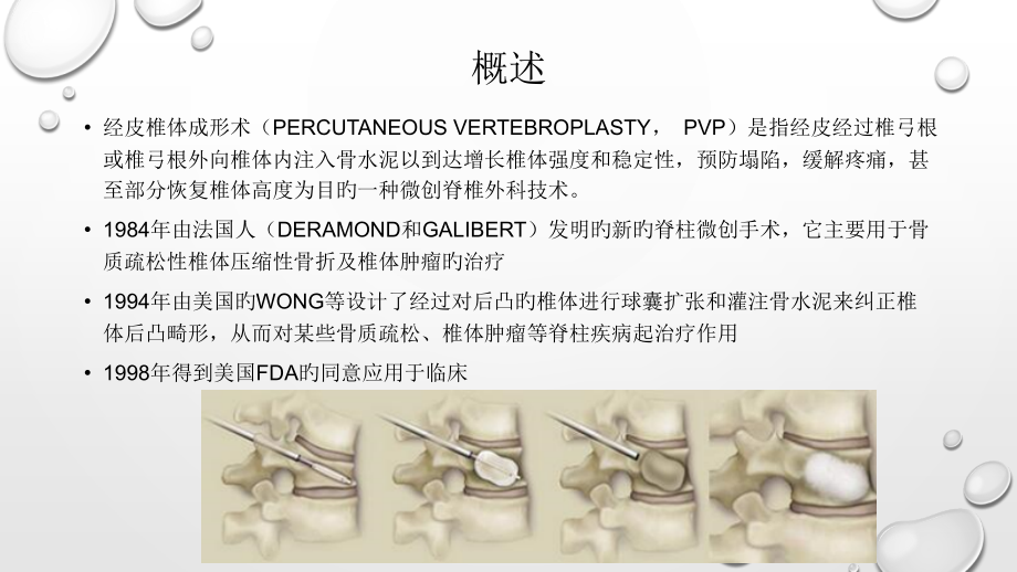 经皮穿刺椎体成形术医疗护理.pptx_第2页