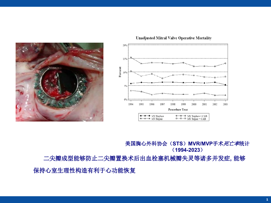 二尖瓣瓣环成形技术分析.ppt_第1页